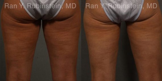 Coolsculpting Elite Before and After Photos in Newburgh, NY, Patient 12459