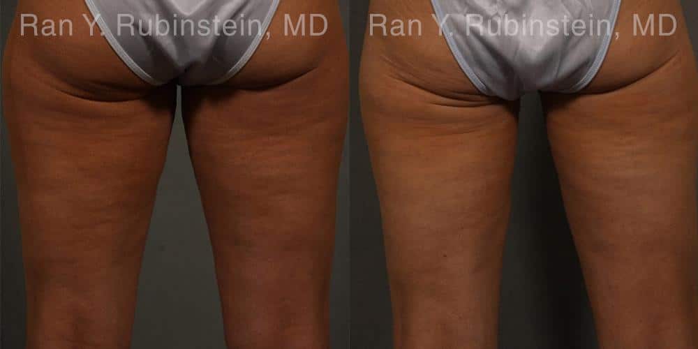 Coolsculpting Elite Before and After Photos in Newburgh, NY, Patient 12459