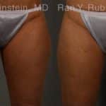 Coolsculpting Elite Before and After Photos in Newburgh, NY, Patient 12459