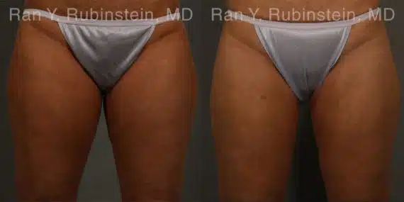 Coolsculpting Elite Before and After Photos in Newburgh, NY, Patient 12459