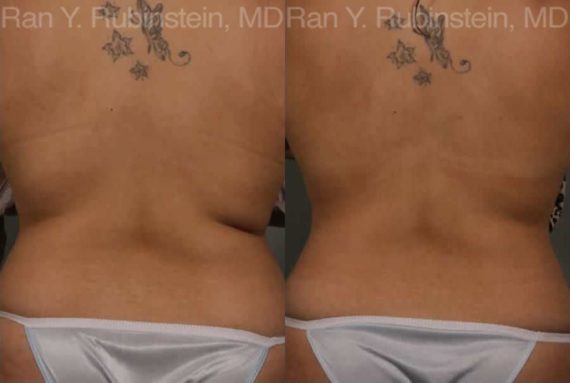 Coolsculpting Elite Before and After Photos in Newburgh, NY, Patient 12464