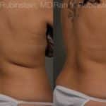 Coolsculpting Elite Before and After Photos in Newburgh, NY, Patient 12464