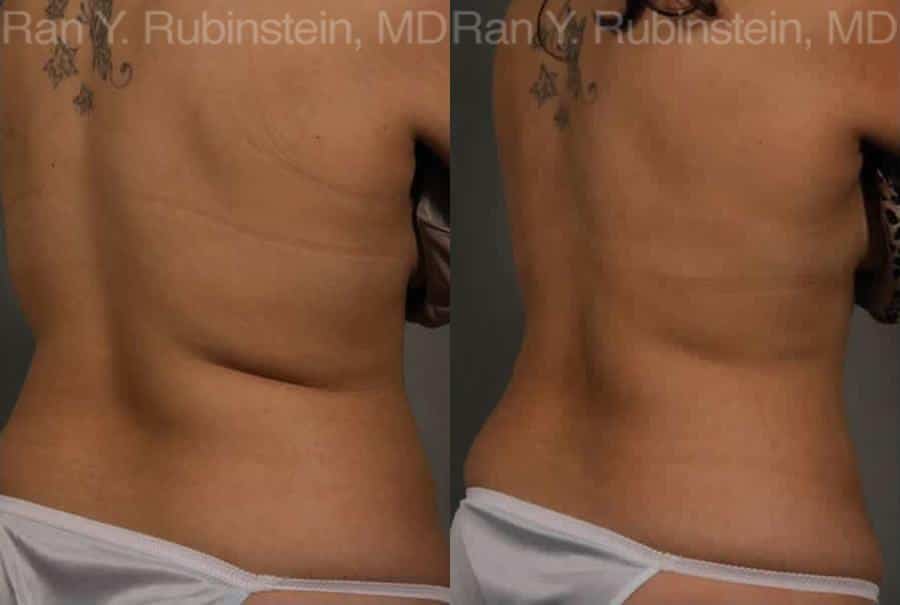 CoolSculpting® Back/Bra Roll Photo Gallery