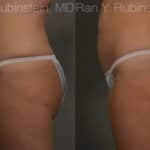 Coolsculpting Elite Before and After Photos in Newburgh, NY, Patient 12469