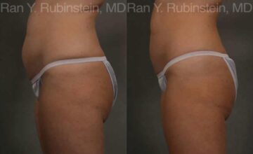 Coolsculpting Elite Before and After Photos in Montvale, NJ, Patient 12469