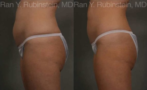 Coolsculpting Elite Before and After Photos in Newburgh, NY, Patient 12469