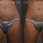 Coolsculpting Elite Before and After Photos in Newburgh, NY, Patient 12469