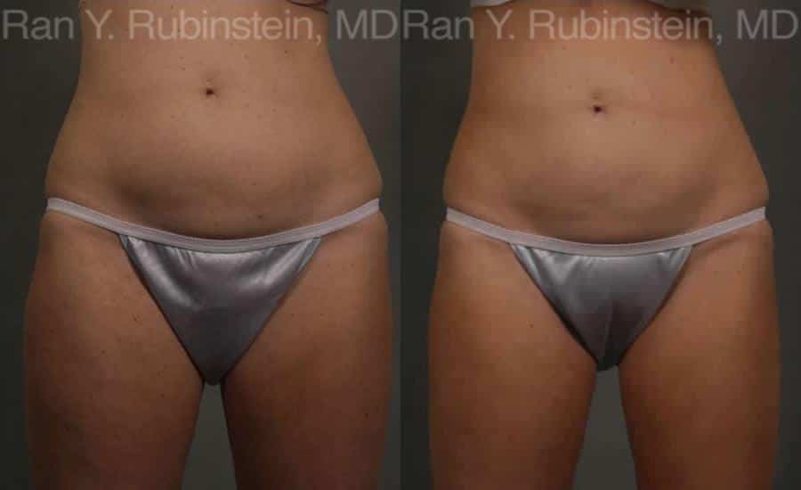 Coolsculpting Elite Before and After Photos in Newburgh, NY, Patient 12469