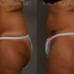 Coolsculpting Elite Before and After Photos in Newburgh, NY, Patient 12474