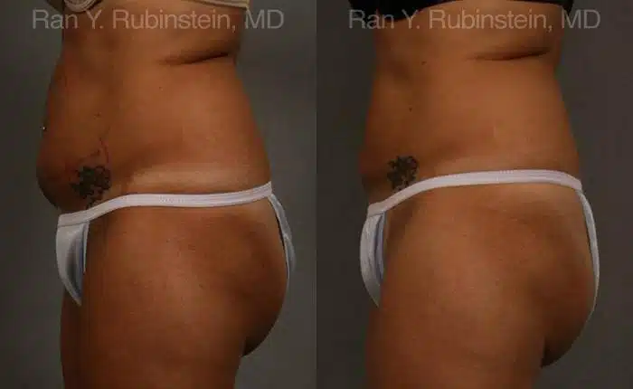 Coolsculpting Elite Before and After Photos in Newburgh, NY, Patient 12474