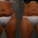 Coolsculpting Elite Before and After Photos in Newburgh, NY, Patient 12474