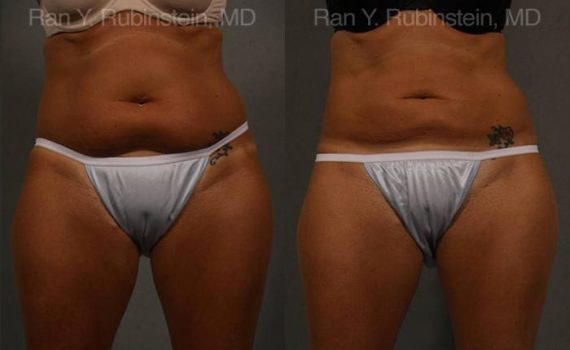 Coolsculpting Elite Before and After Photos in Newburgh, NY, Patient 12474