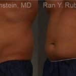 Coolsculpting Elite Before and After Photos in Newburgh, NY, Patient 12479