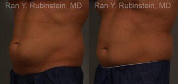 Coolsculpting Elite Before and After Photos in Montvale, NJ, Patient 12479