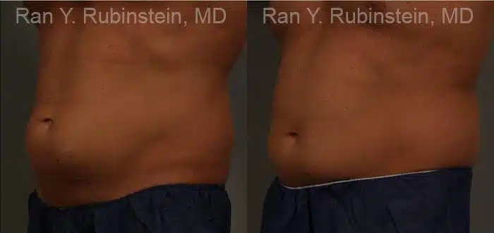 Coolsculpting Elite Before and After Photos in Newburgh, NY, Patient 12479