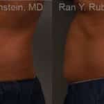 Coolsculpting Elite Before and After Photos in Newburgh, NY, Patient 12479