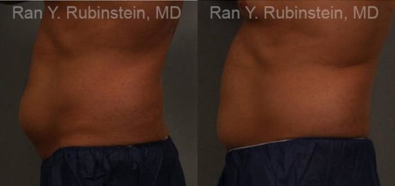 Coolsculpting Elite Before and After Photos in Newburgh, NY, Patient 12479