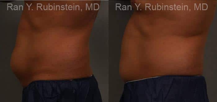 Coolsculpting Elite Before and After Photos in Newburgh, NY, Patient 12479