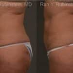 Coolsculpting Elite Before and After Photos in Newburgh, NY, Patient 12484