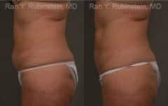 Coolsculpting Elite Before and After Photos in Newburgh, NY, Patient 12484