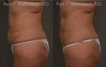 Coolsculpting Elite Before and After Photos in Montvale, NJ, Patient 12484