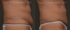 Coolsculpting Elite Before and After Photos in Newburgh, NY, Patient 12487