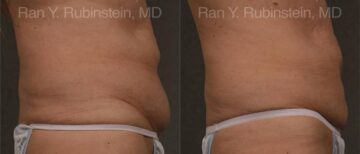 Coolsculpting Elite Before and After Photos in Montvale, NJ, Patient 12487
