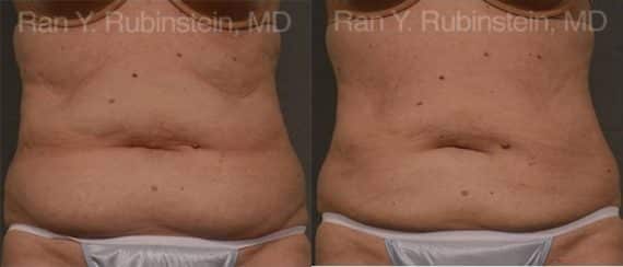 Coolsculpting Elite Before and After Photos in Newburgh, NY, Patient 12487