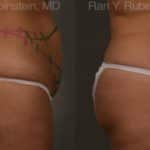 Coolsculpting Elite Before and After Photos in Newburgh, NY, Patient 12492