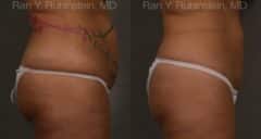 Coolsculpting Elite Before and After Photos in Newburgh, NY, Patient 12492