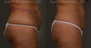 Coolsculpting Elite Before and After Photos in Montvale, NJ, Patient 12492
