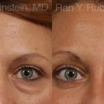 Eyelid Surgery Before and After Photos in Newburgh, NY, Patient 12591