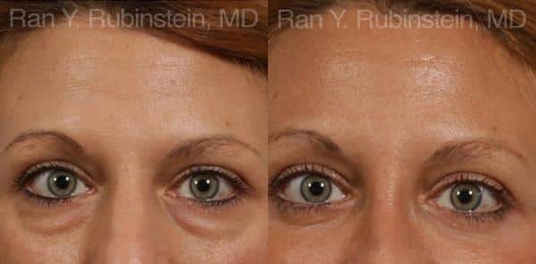 Eyelid Surgery Before and After Photos in Newburgh, NY, Patient 12591