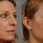 Eyelid Surgery Before and After Photos in Newburgh, NY, Patient 12591