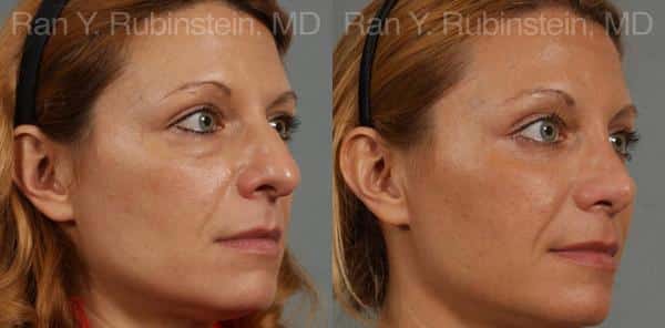 Eyelid Surgery Before and After Photos in Newburgh, NY, Patient 12591