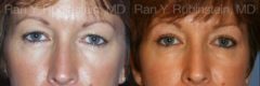 Eyelid Surgery Before and After Photos in Newburgh, NY, Patient 12616