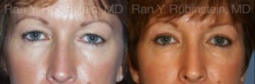 Eyelid Surgery Before and After Photos in Montvale, NJ, Patient 12616