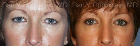 Eyelid Surgery Before and After Photos in Newburgh, NY, Patient 12616