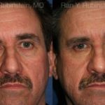 Fat Transfer Before and After Photos in Newburgh, NY, Patient 12694