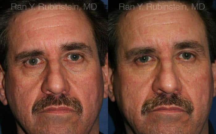 Fat Transfer Before and After Photos in Newburgh, NY, Patient 12694