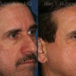 Fat Transfer Before and After Photos in Newburgh, NY, Patient 12694