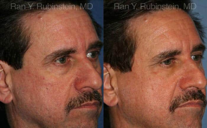 Fat Transfer Before and After Photos in Newburgh, NY, Patient 12694