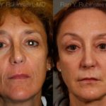 Sculptra Face Before and After Photos in Newburgh, NY, Patient 12699