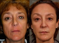 Sculptra Face Before and After Photos in Newburgh, NY, Patient 12699