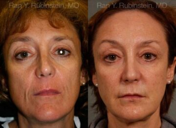 Sculptra Face Before and After Photos in Montvale, NJ, Patient 12699