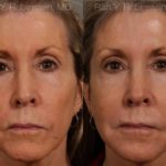 Dermal Fillers Before and After Photos in Newburgh, NY, Patient 12702