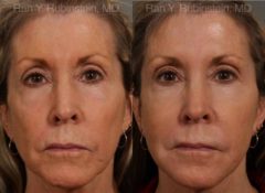 Dermal Fillers Before and After Photos in Newburgh, NY, Patient 12702