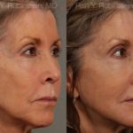 Dermal Fillers Before and After Photos in Newburgh, NY, Patient 12702