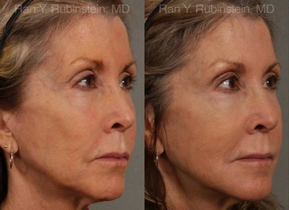 Dermal Fillers Before and After Photos in Newburgh, NY, Patient 12702