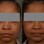 Dermal Fillers Before and After Photos in Newburgh, NY, Patient 12707